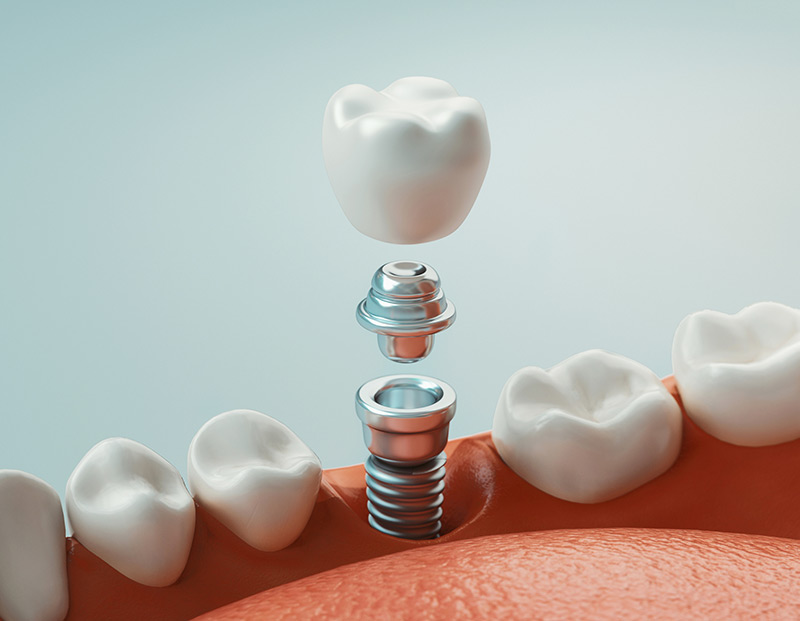 dental-implants